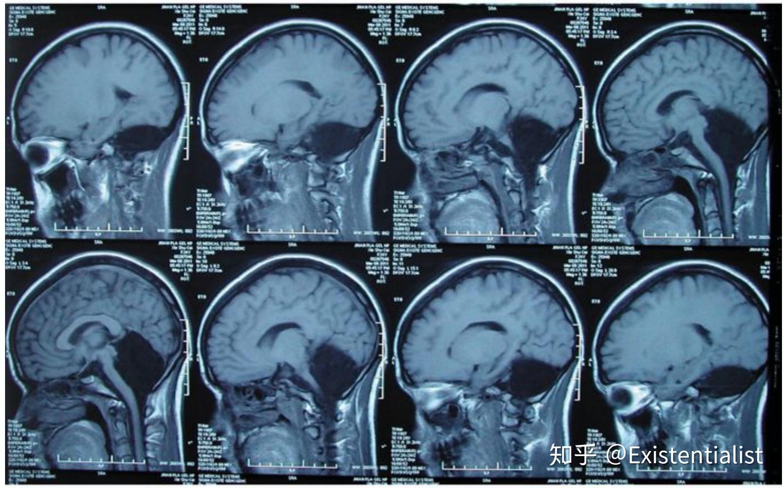 [电报性语言是小脑]电报式语言的特征是什么