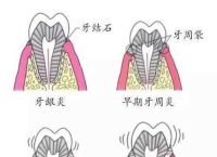 炎细胞5070%是什么意思,炎细胞50%75%是什么意思